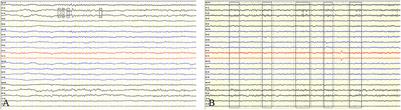 Case report: Varicella-zoster virus infection triggering progressive encephalomyelitis with rigidity and myoclonus